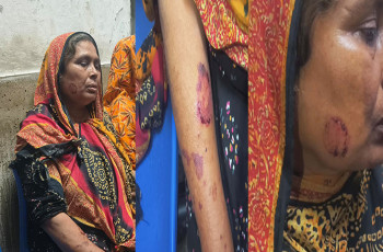 পারিবারিক কলহ: বউয়ের মায়ের কামড়ে হাসপাতালে স্বামীর মা