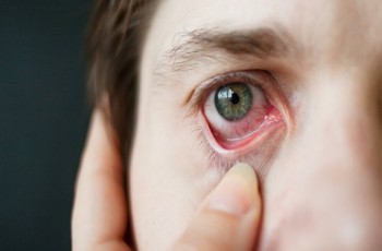 চোখ উঠলে কী করবেন, কী করবেন না